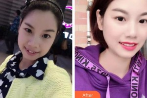 長春白求恩口腔醫(yī)院孫凱整形價(jià)格表附金屬托槽矯正案例展示