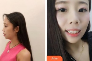 四平市中心醫(yī)院整形美容科張聰整形價格表附牙齒隱形矯正案例展示