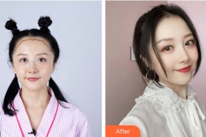 南昌佳美美容醫(yī)院粟東整形價格表附植發(fā)案例展示