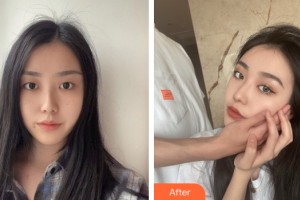 南昌俊雅醫(yī)療美容醫(yī)院曾輝整形價格表附眼部手術(shù)案例展示