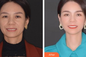 佳木斯婦幼保健院醫(yī)學整形美容科趙博整形價格表附牙齒矯正案例展示