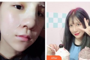 白山漢誠醫(yī)療美容門診部管齊花整形價(jià)格表附鼻部綜合案例展示