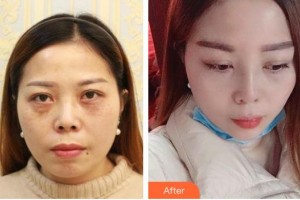 松原富華整形美容醫(yī)院岳洪忠整形價(jià)格表附鼻部綜合案例展示