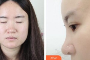 松原齊飛美容外科門診部杜彥超整形價(jià)格表附耳軟骨復(fù)合隆鼻案例展示