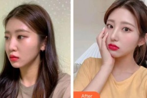 松原齊飛美容外科門診部周春玲整形價(jià)格表附鼻部綜合案例展示