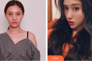 松原銘醫(yī)整形美容醫(yī)院徐曉宇整形價(jià)格表附硅膠隆鼻案例展示