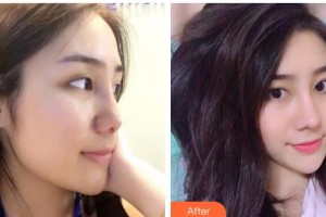 陜西省人民醫(yī)院燒傷整形醫(yī)學(xué)美容科孫要文整形價(jià)格表附鼻部綜合案例展示