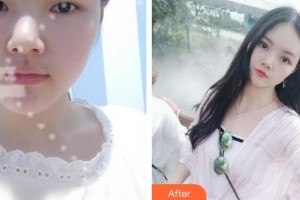 陜西省第二人民醫(yī)院眼科楊宇紅整形價格表附眼部綜合案例展示