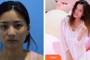 陜西華西醫(yī)院西美整形美容中心程艷整形價(jià)格表附切開雙眼皮案例展示