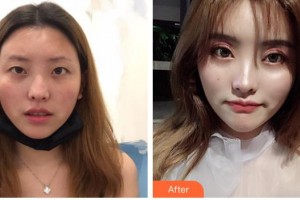 陜西省友誼醫(yī)院醫(yī)學整形科張潔整形價格表附定點雙眼皮案例展示