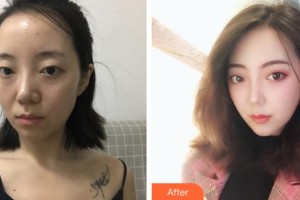 陜西電子409醫(yī)院整形外科張曄整形價格表附切開雙眼皮案例展示