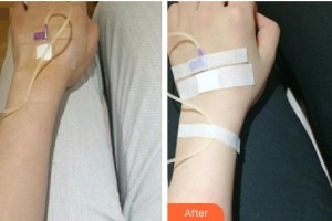 寶雞中心醫(yī)院燒傷整形科習(xí)耀峰整形價(jià)格表附美白導(dǎo)入案例展示