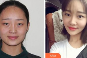 寶雞人民醫(yī)院整形美容科郭建整形價格表附光子嫩膚案例展示