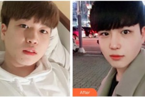 寶雞韓美醫(yī)療美容門診部林大植 整形價格表附去痘印痘坑案例展示