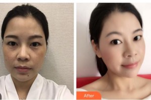 寶雞高新人民醫(yī)院整形美容外科景海鵬整形價(jià)格表附眼部綜合案例展示