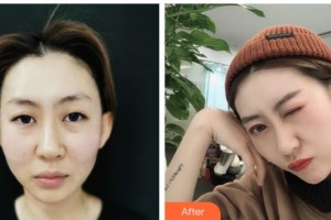 寶雞韓美醫(yī)療美容門診部何在成 整形價(jià)格表附切開雙眼皮案例展示