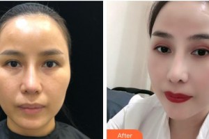 寶雞韓美醫(yī)療美容門診部李元澤 整形價(jià)格表附開內(nèi)眼角案例展示