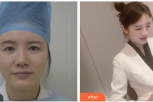 寶雞高一生醫(yī)療美容門醫(yī)院張進(jìn)南整形價(jià)格表附上眼瞼去脂案例展示