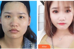 寶雞麗人婦科醫(yī)院醫(yī)療美容科竺湘云整形價格表附切開雙眼皮案例展示