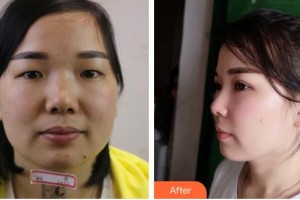 寶雞高新人民醫(yī)院整形美容外科呂成整形價(jià)格表附眼部綜合案例展示