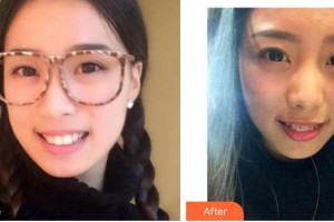 寶雞市口腔醫(yī)院趙芳萍整形價(jià)格表附金屬托槽矯正案例展示