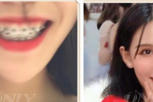 寶雞市口腔醫(yī)院曹蓓整形價(jià)格表附牙貼面案例展示