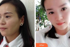 寶雞市口腔醫(yī)院華耀社整形價(jià)格表附隱形托槽矯正案例展示