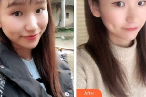 寶雞市口腔醫(yī)院逯明整形價格表附牙貼面案例展示