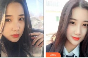 寶雞市口腔醫(yī)院任小望整形價格表附冷光美白案例展示