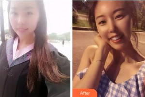 寶雞市口腔醫(yī)院王高社整形價格表附牙齒陶瓷矯正案例展示