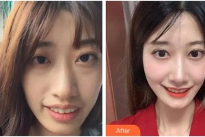 寶雞市口腔醫(yī)院馮光偉整形價格表附牙齒陶瓷矯正案例展示