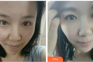 常熟市第一人民醫(yī)院燒傷整形科錢鐵石整形價(jià)格表附紅藍(lán)光祛痘案例展示