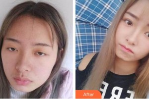 常熟市第二人民醫(yī)院眼科邢茜整形價格表附切開雙眼皮案例展示