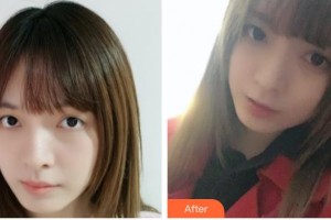 常熟市第二人民醫(yī)院眼科陸炯整形價格表附切開雙眼皮案例展示