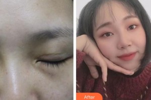 常熟市第二人民醫(yī)院眼科秦燕整形價格表附眼部修復(fù)案例展示