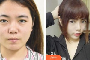 常熟市第二人民醫(yī)院眼科陶建軍整形價格表附眼部綜合案例展示