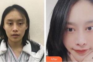 常熟市第二人民醫(yī)院眼科李函整形價格表附內(nèi)切祛眼袋案例展示