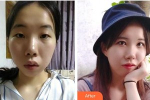 常熟廣仁醫(yī)院眼科盛敏杰整形價(jià)格表附眼部綜合案例展示