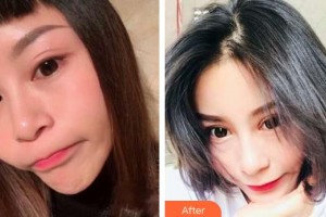 常熟廣仁醫(yī)院眼科劉新泉整形價格表附切開雙眼皮案例展示