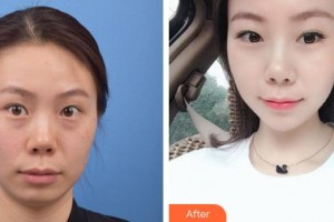 貴州整形美容外科醫(yī)院張智毅整形價格表附光子嫩膚案例展示