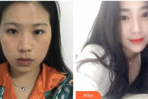 貴州省第二人民醫(yī)院整形外科左路整形價格表附激光祛斑案例展示