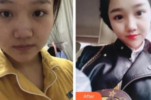 貴州省紅十字會婦女兒童醫(yī)院整形美容中心謝詩思整形價格表附紅藍光祛痘案例展示