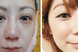 貴州省人民醫(yī)院整形美容燒傷顯微外科程代薇整形價格表附光子嫩膚案例展示