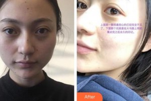 貴州省紅十字會婦女兒童醫(yī)院整形美容中心曾寧川整形價格表附激光點痣案例展示