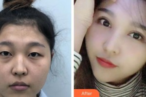 貴州醫(yī)科大學第二附屬醫(yī)院醫(yī)學美容整形外科楊光朝整形價格表附眼部綜合案例展示