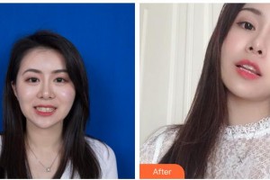 貴州晶朗眼科醫(yī)院趙國義整形價格表附金屬托槽矯正案例展示