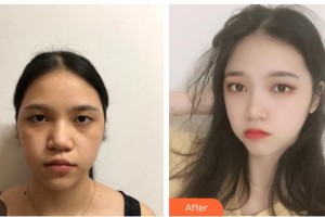 貴州整形美容外科醫(yī)院王家順整形價格表附牙貼面案例展示