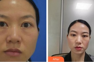 貴州晶朗眼科醫(yī)院姚曉明整形價(jià)格表附眼部修復(fù)案例展示