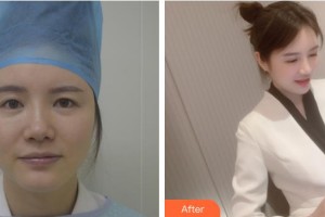 貴州晶朗眼科醫(yī)院王明武整形價(jià)格表附上眼瞼去脂案例展示