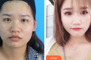 貴州晶朗眼科醫(yī)院陳曦整形價(jià)格表附切開雙眼皮案例展示